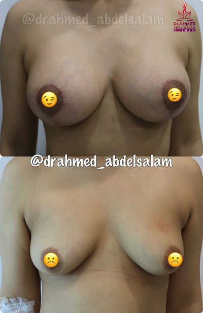 Cases in Augmentation Mastopexy