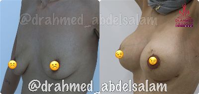 Cases in Augmentation Mastopexy