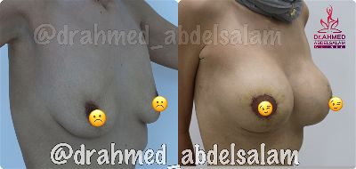 Cases in Augmentation Mastopexy