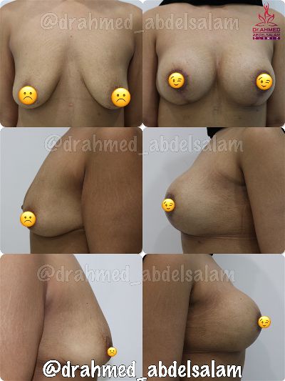 Cases in Augmentation Mastopexy