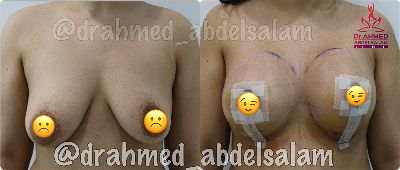 Cases in Augmentation Mastopexy