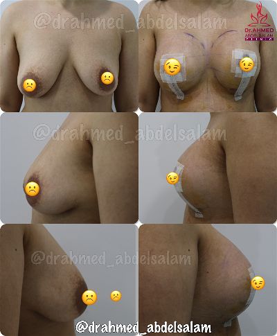 Cases in Augmentation Mastopexy