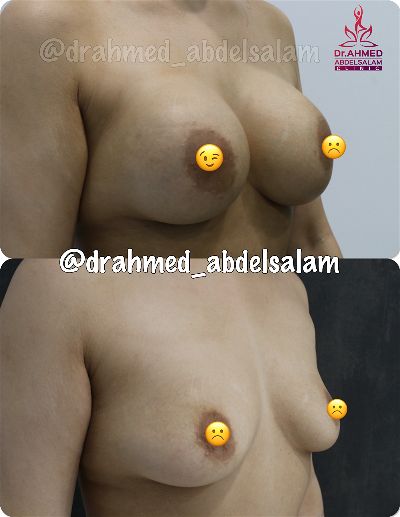 Cases in Breast Augmentation