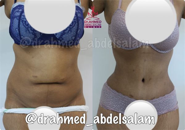 cases in Abdominoplasty