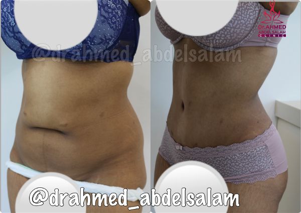 cases in Abdominoplasty