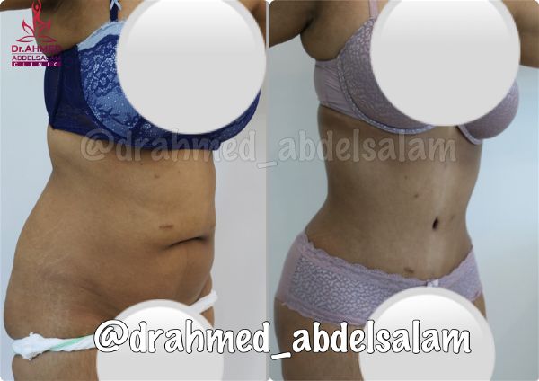 cases in Abdominoplasty