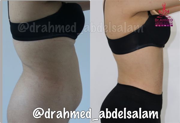 cases in Abdominoplasty