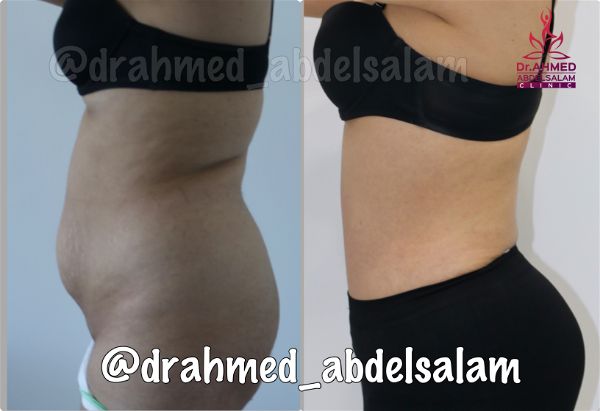 cases in Abdominoplasty