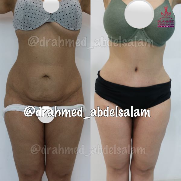 cases in Abdominoplasty