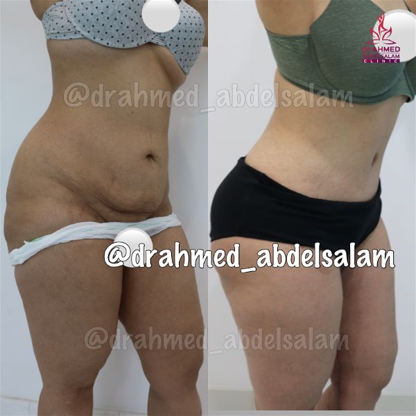 cases in Abdominoplasty