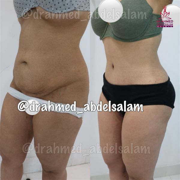 cases in Abdominoplasty