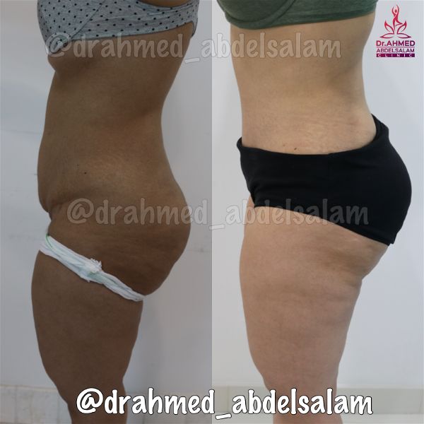 cases in Abdominoplasty