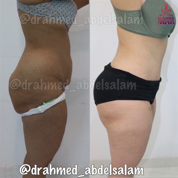 cases in Abdominoplasty