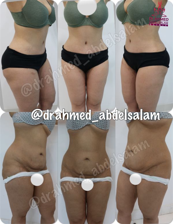 cases in Abdominoplasty