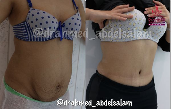 cases in Abdominoplasty