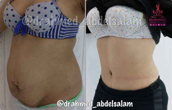 cases in Abdominoplasty