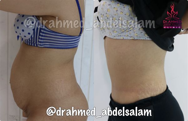 cases in Abdominoplasty