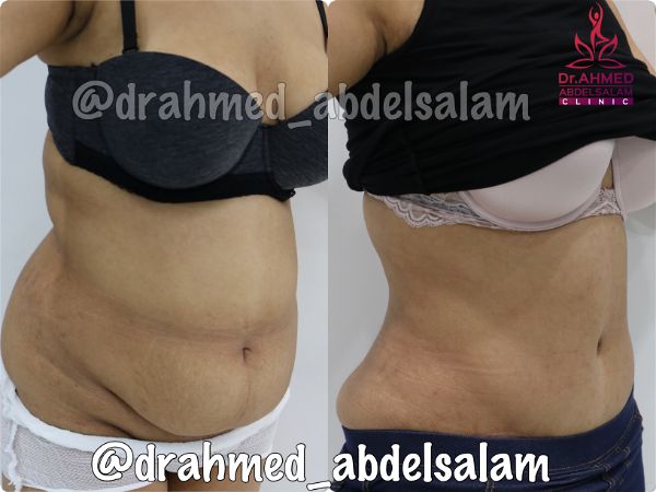 cases in Abdominoplasty