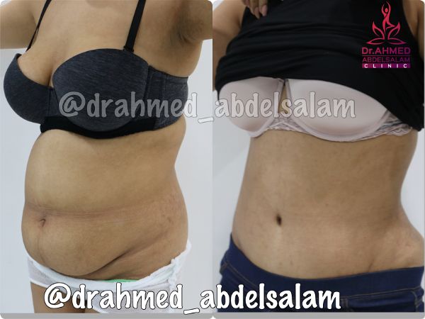 cases in Abdominoplasty