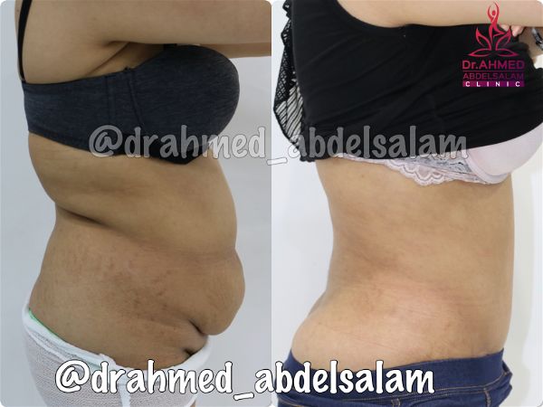 cases in Abdominoplasty