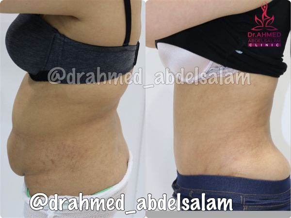 cases in Abdominoplasty