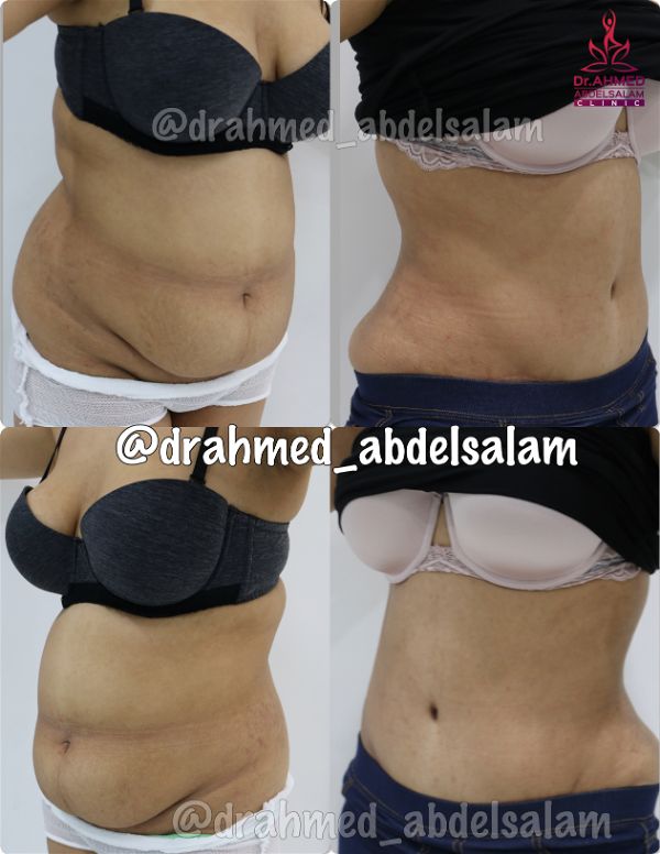 cases in Abdominoplasty