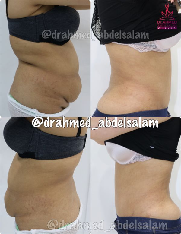 cases in Abdominoplasty