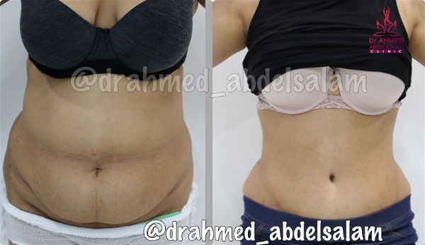 cases in Abdominoplasty