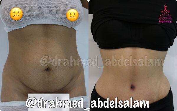 cases in Abdominoplasty