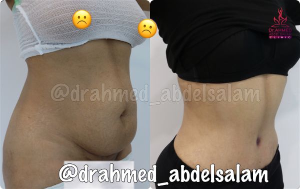 cases in Abdominoplasty