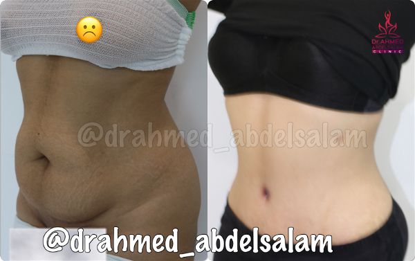 cases in Abdominoplasty