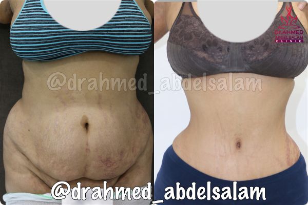 cases in Abdominoplasty