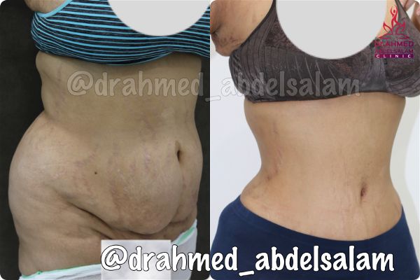 cases in Abdominoplasty