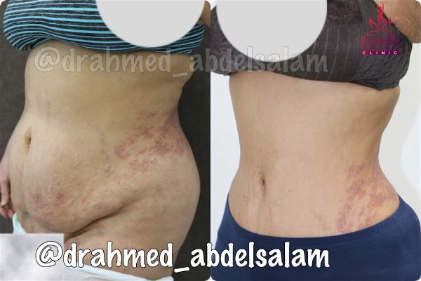 cases in Abdominoplasty