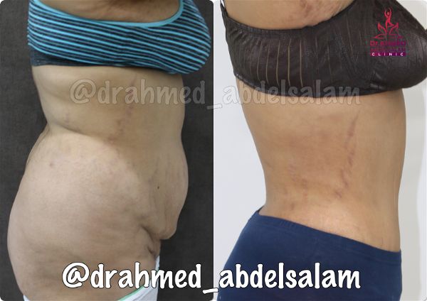 cases in Abdominoplasty