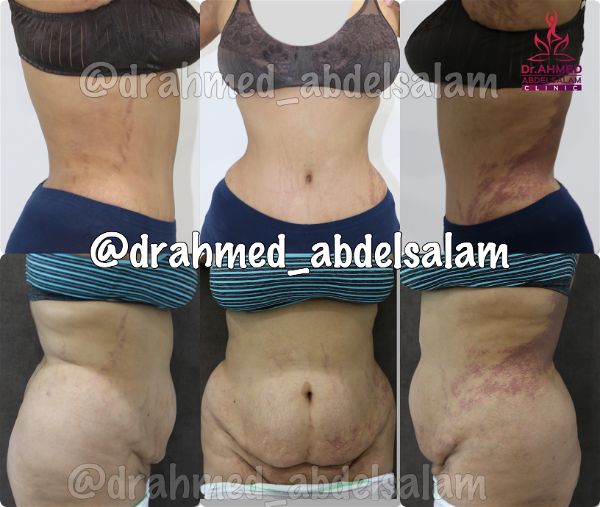 cases in Abdominoplasty