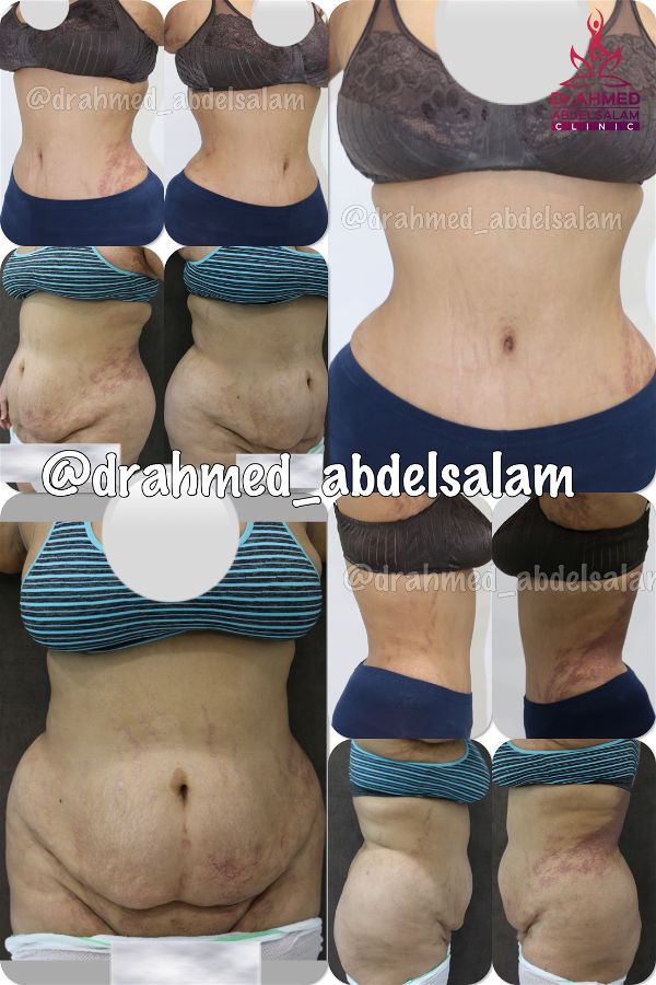 cases in Abdominoplasty