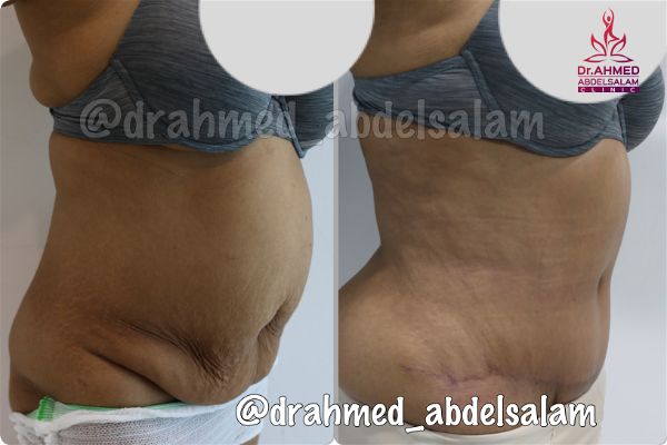 cases in Abdominoplasty