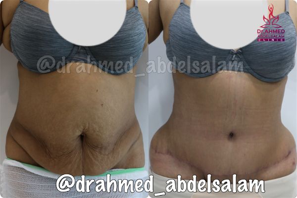 cases in Abdominoplasty