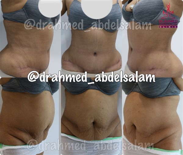 cases in Abdominoplasty