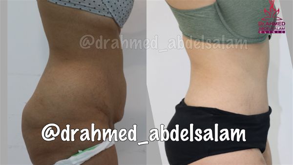 cases in Abdominoplasty