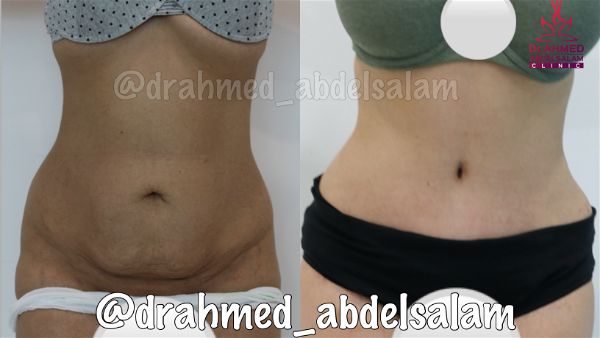 cases in Abdominoplasty