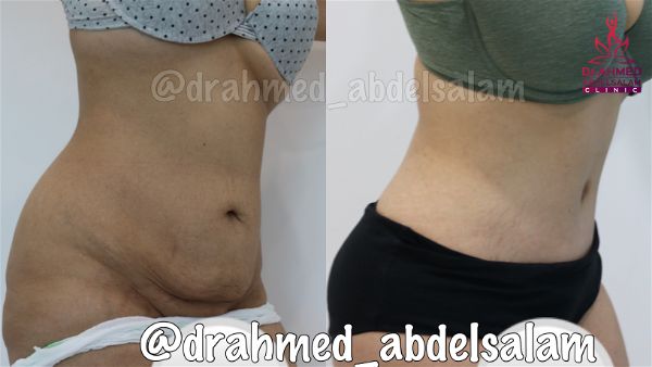 cases in Abdominoplasty