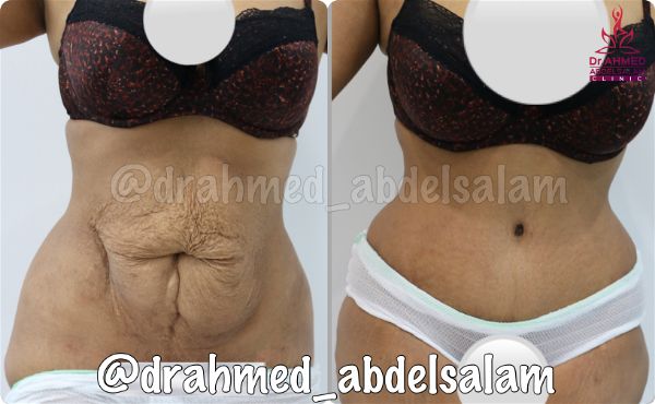 cases in Abdominoplasty