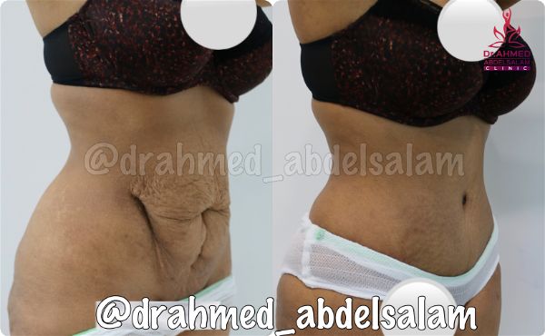 cases in Abdominoplasty