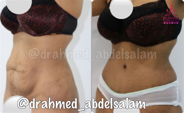 cases in Abdominoplasty