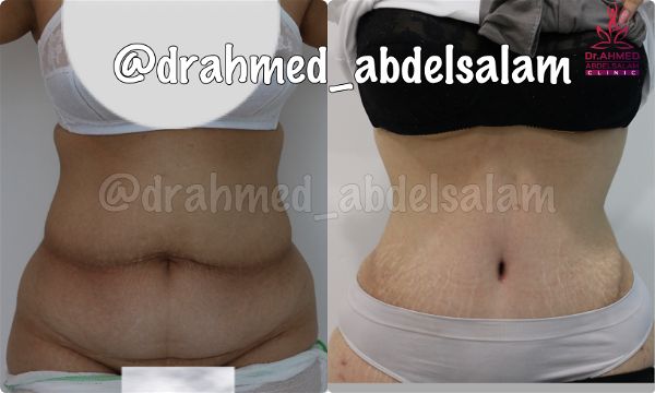 cases in Abdominoplasty