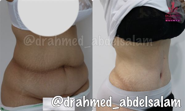 cases in Abdominoplasty