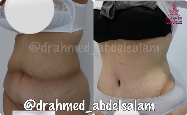 cases in Abdominoplasty