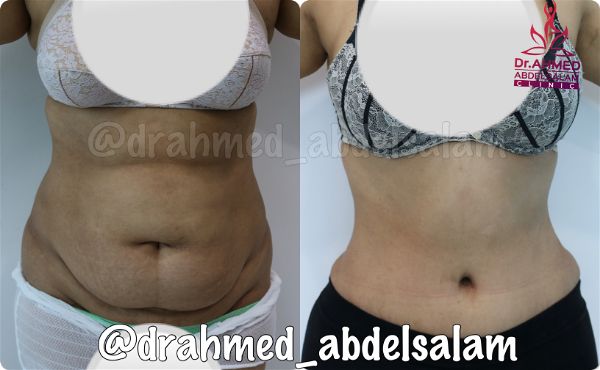 cases in Abdominoplasty